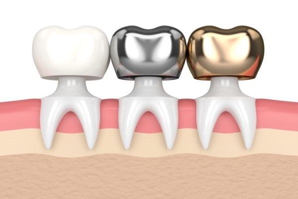 Types Of Materials Available For My Dental Crown